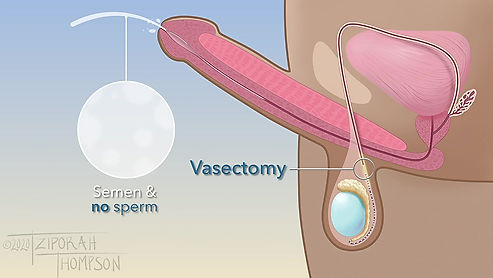 Vasectomy Procedure for Patients - Sample